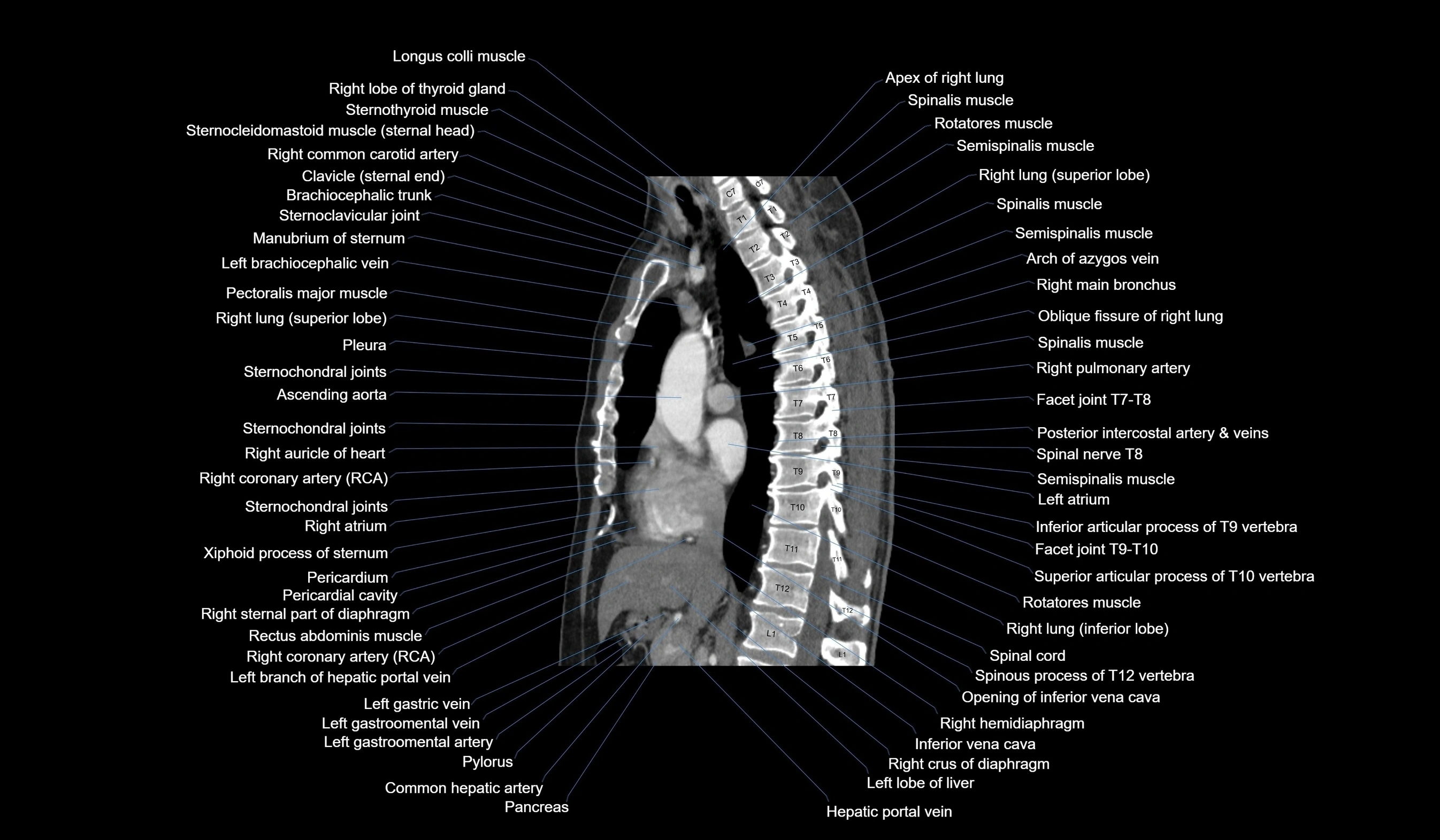 CT chest (thorax) labelled sagittal cross sectional anatomy radiology image-00069.webp